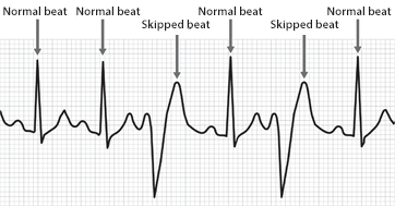 What an Irregular Heart Beat? |